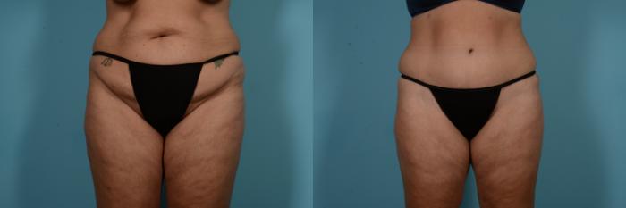 Before & After Tummy Tuck Case 769 Front View in Chicago, IL