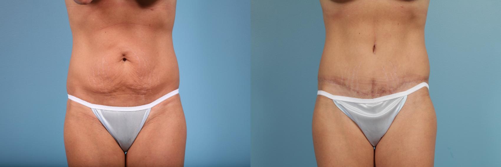Before & After Tummy Tuck by Dr. Mustoe Case 103 View #1 View in Chicago, IL