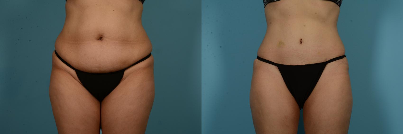 Before & After Tummy Tuck by Dr. Mustoe Case 1049 Front View in Chicago, IL