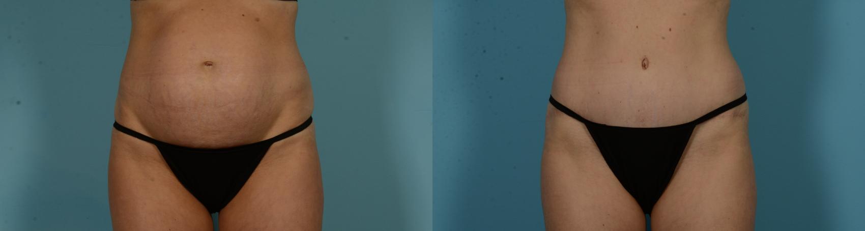 Before & After Tummy Tuck by Dr. Mustoe Case 1056 Front View in Chicago, IL