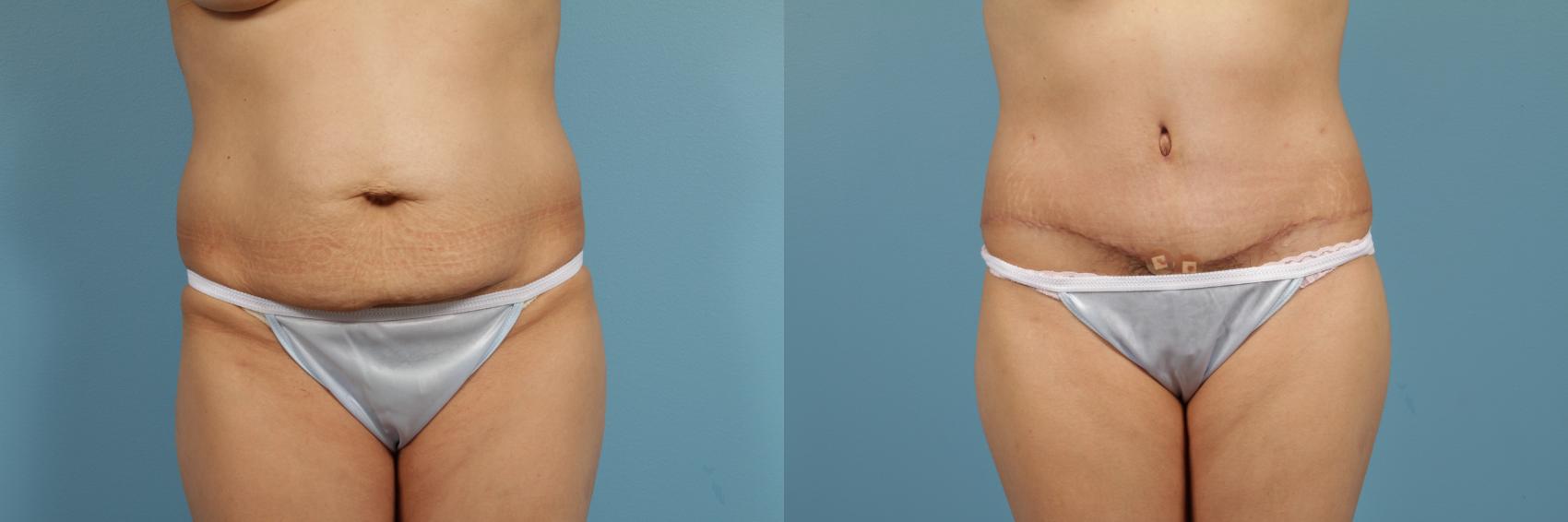 Before & After Tummy Tuck by Dr. Mustoe Case 148 View #1 View in Chicago, IL