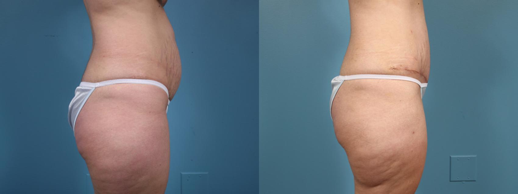 Before & After Tummy Tuck by Dr. Mustoe Case 15 View #1 View in Chicago, IL