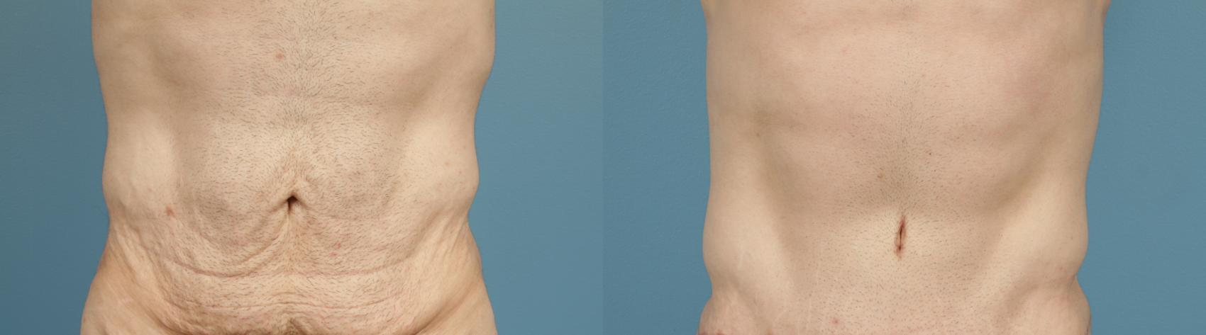 Before & After Tummy Tuck by Dr. Mustoe Case 166 Front View in Chicago, IL