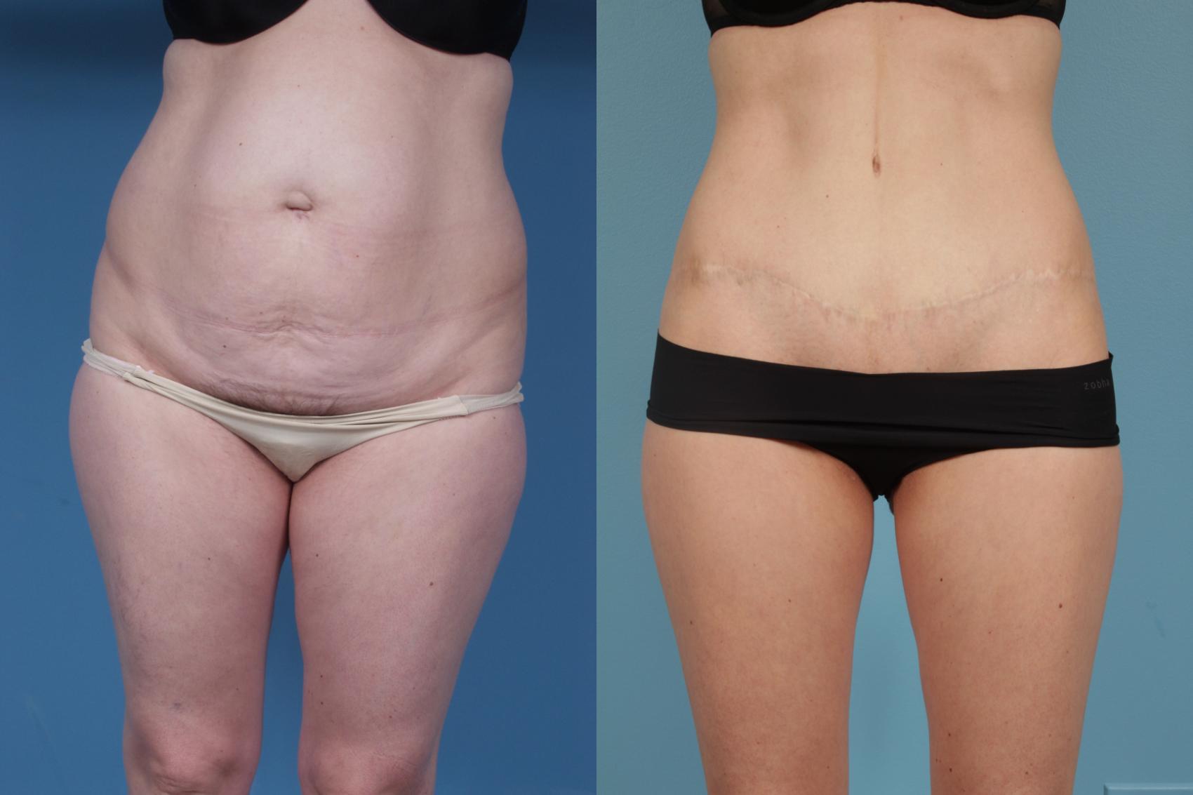 Before & After Tummy Tuck by Dr. Mustoe Case 176 View #1 View in Chicago, IL