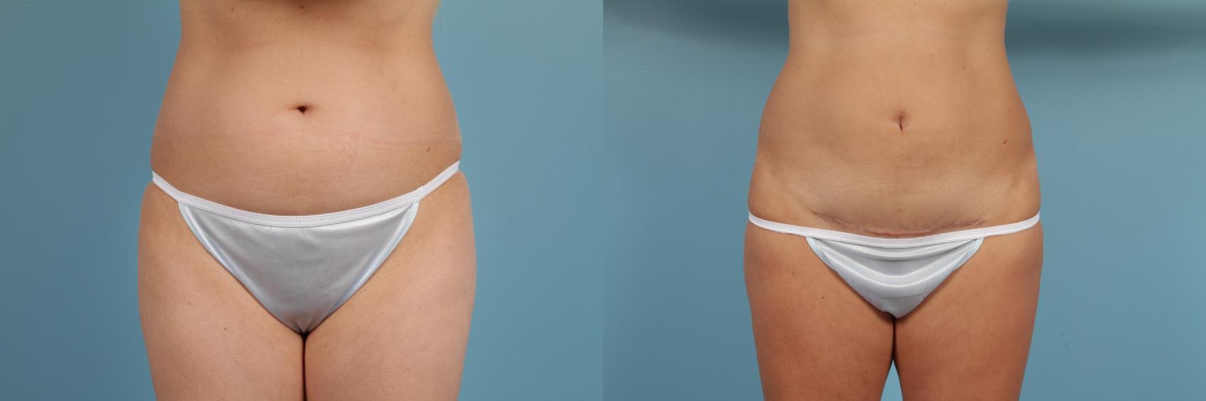 Before & After Tummy Tuck by Dr. Mustoe Case 192 View #1 View in Chicago, IL