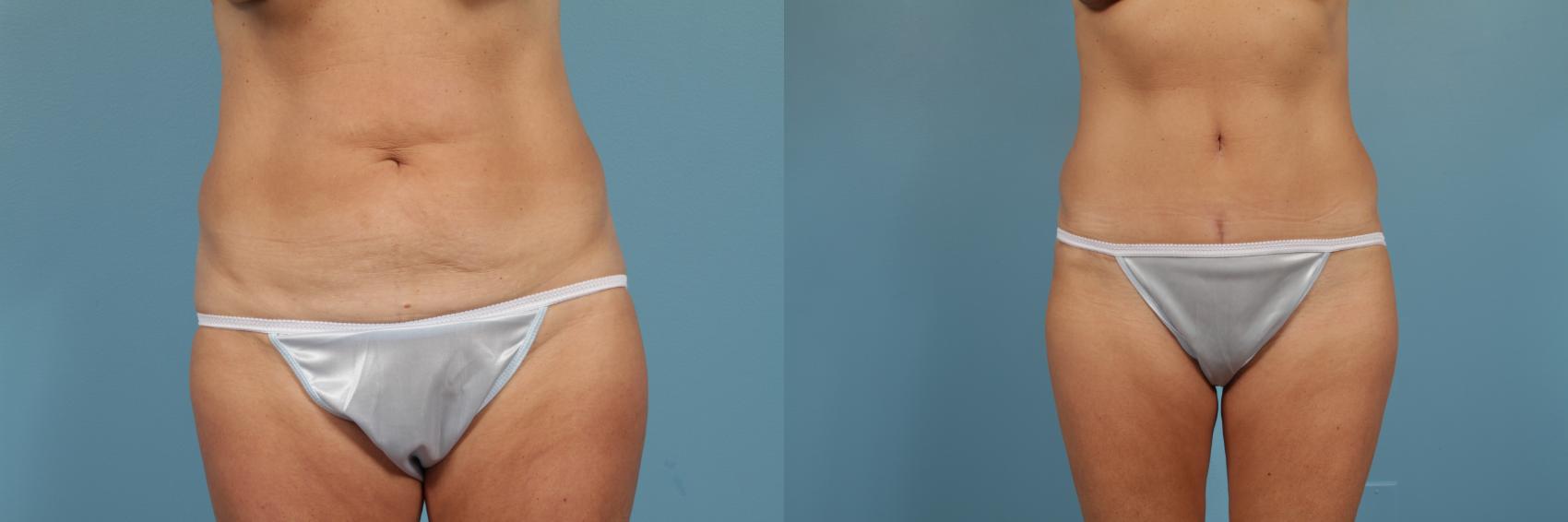 Before & After Tummy Tuck by Dr. Mustoe Case 203 View #1 View in Chicago, IL