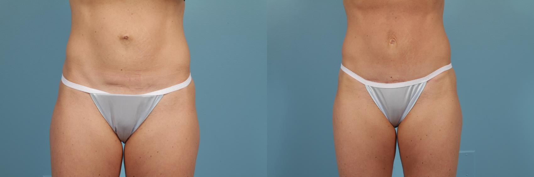 Before & After Tummy Tuck by Dr. Mustoe Case 212 View #1 View in Chicago, IL