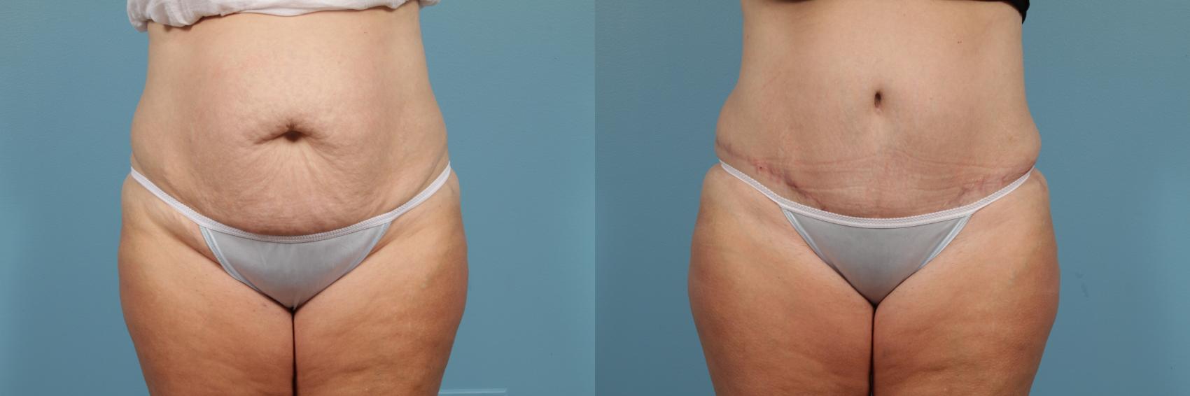 Before & After Tummy Tuck by Dr. Mustoe Case 213 View #1 View in Chicago, IL