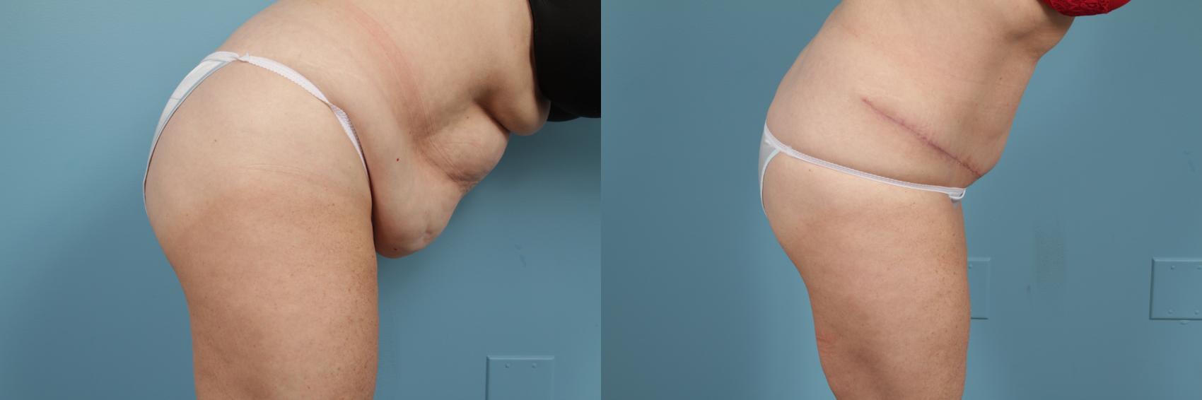 Before & After Tummy Tuck by Dr. Mustoe Case 222 View #1 View in Chicago, IL