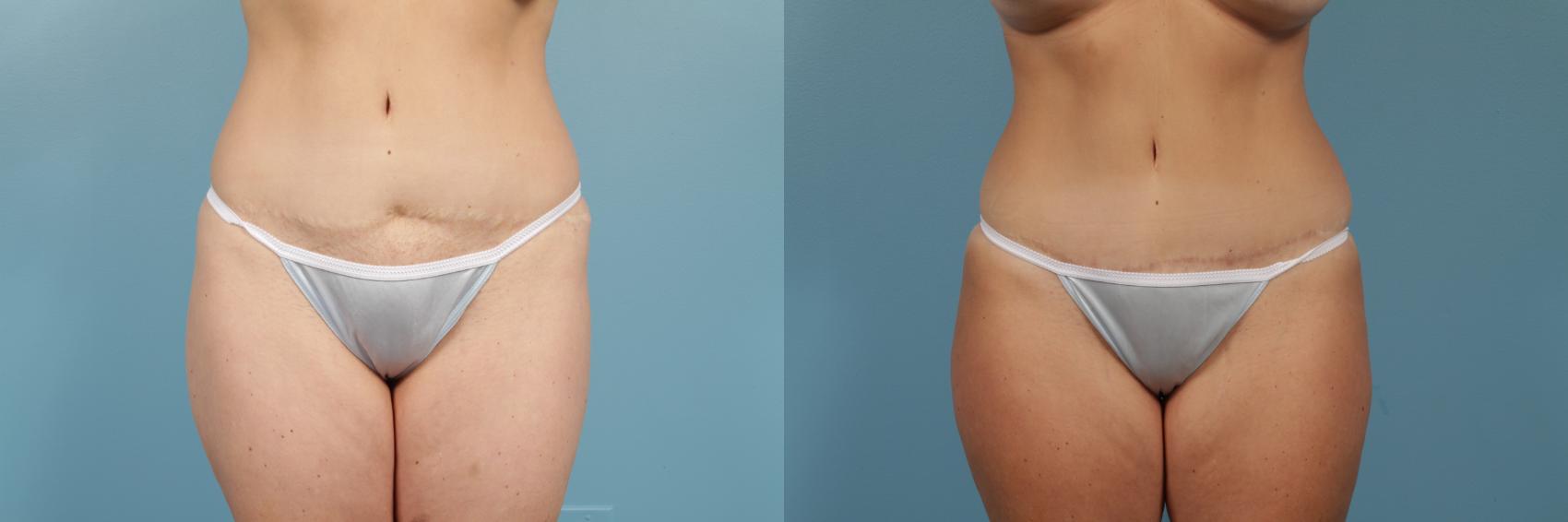 Before & After Tummy Tuck by Dr. Mustoe Case 251 View #1 View in Chicago, IL