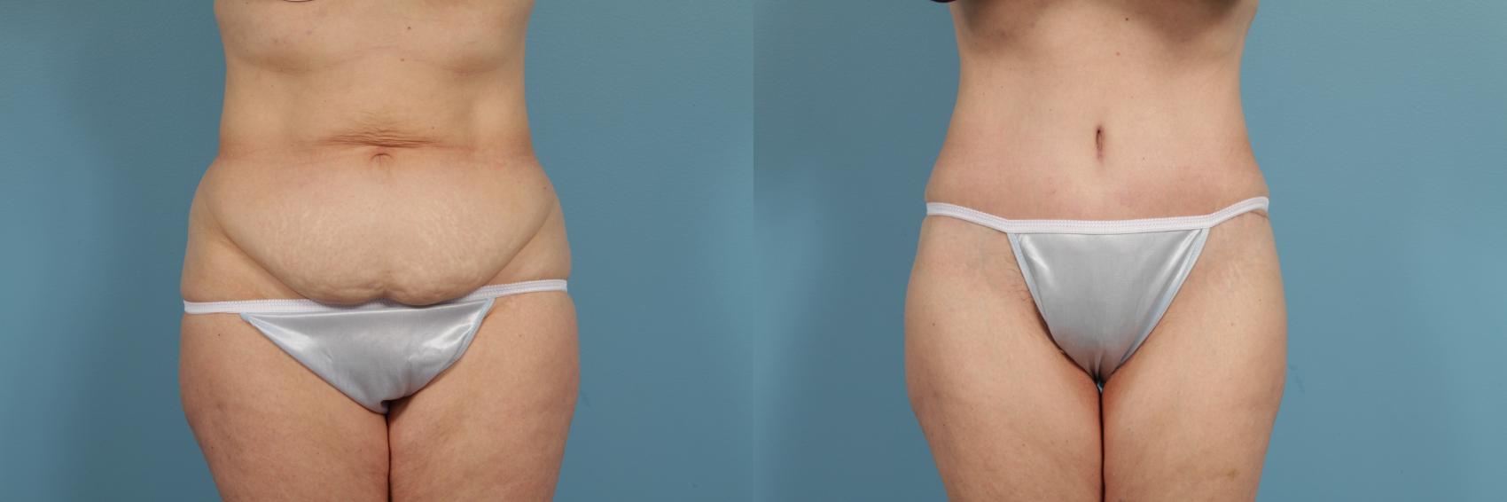 Before & After Tummy Tuck by Dr. Mustoe Case 260 View #1 View in Chicago, IL