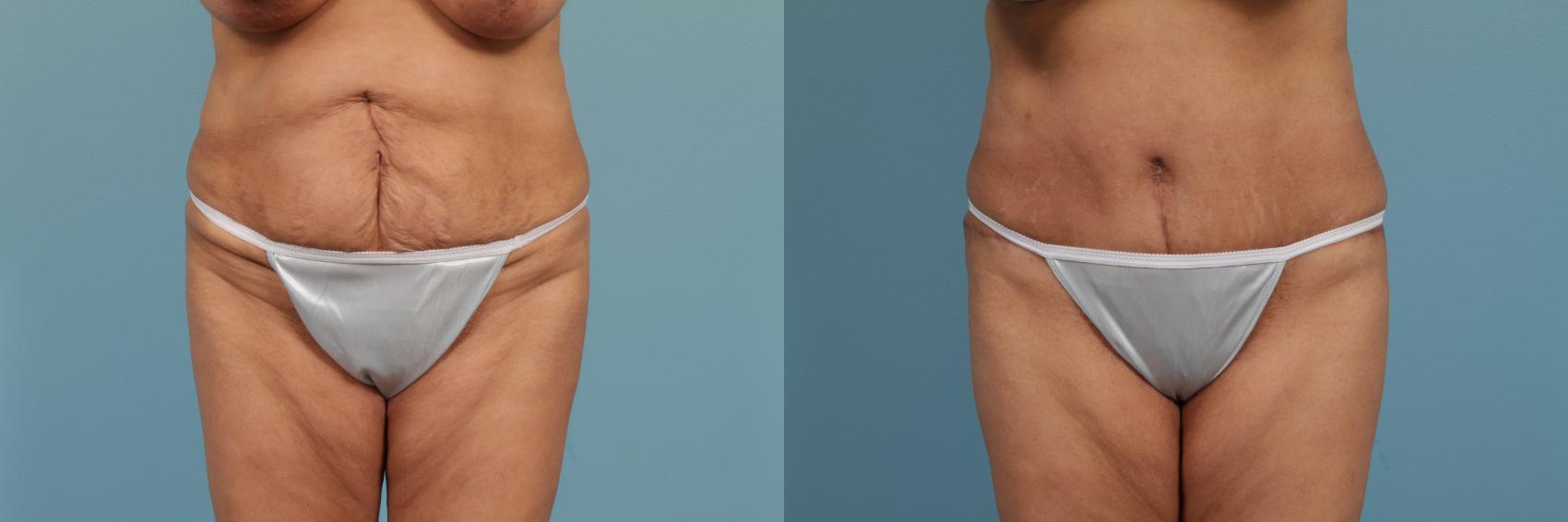 Before & After Tummy Tuck by Dr. Mustoe Case 266 View #1 View in Chicago, IL