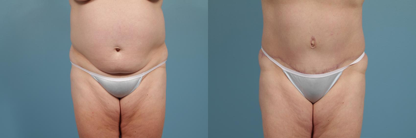Before & After Tummy Tuck by Dr. Mustoe Case 272 View #1 View in Chicago, IL