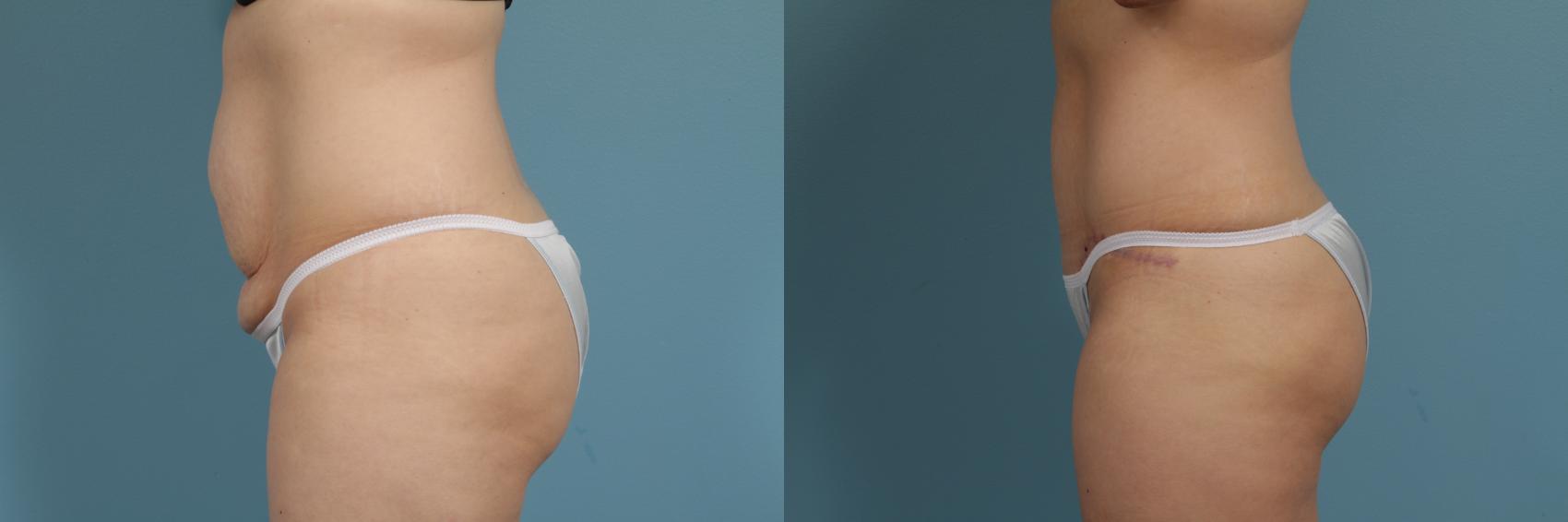 Before & After Tummy Tuck by Dr. Mustoe Case 283 View #1 View in Chicago, IL