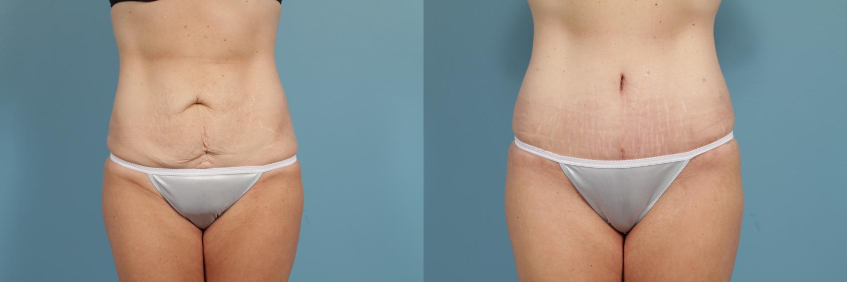 Before & After Tummy Tuck by Dr. Mustoe Case 293 View #1 View in Chicago, IL