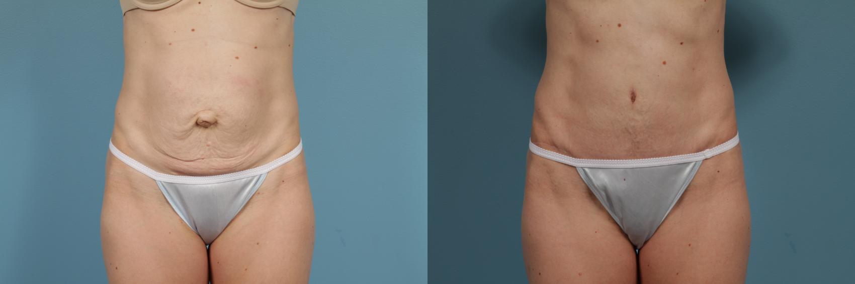 Before & After Tummy Tuck by Dr. Mustoe Case 294 View #1 View in Chicago, IL