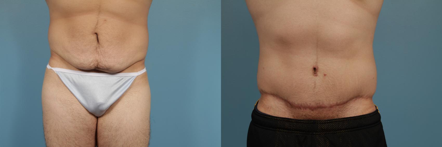 Before & After Tummy Tuck by Dr. Mustoe Case 296 View #1 View in Chicago, IL
