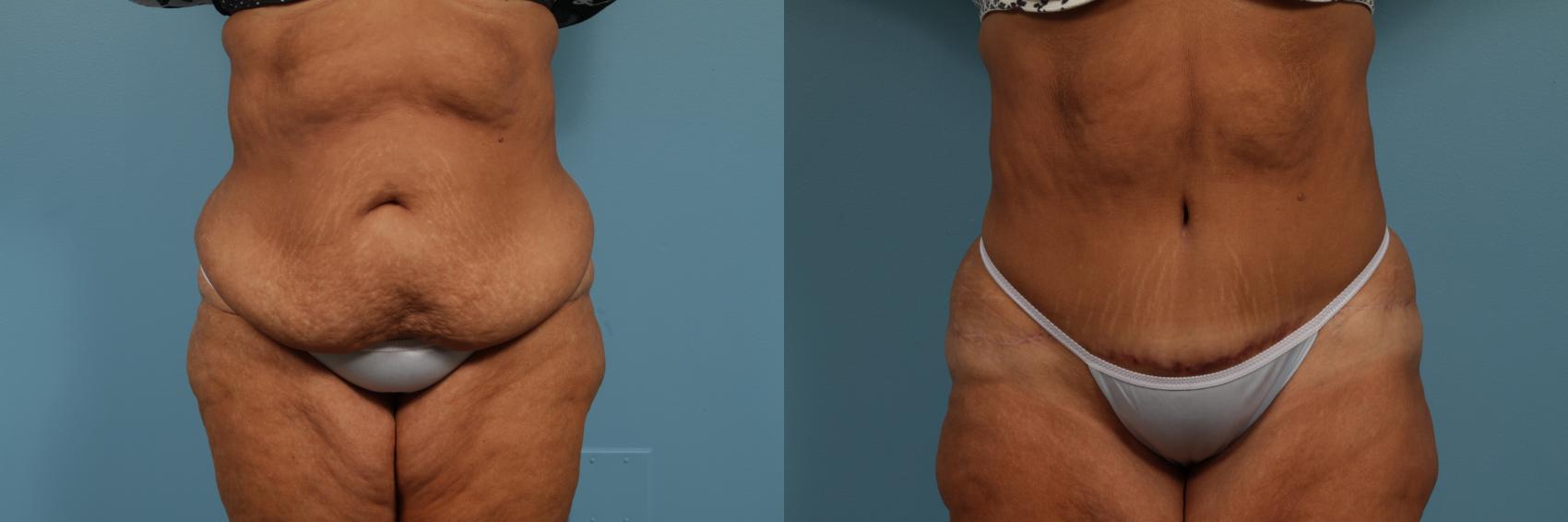 Before & After Tummy Tuck by Dr. Mustoe Case 297 View #1 View in Chicago, IL