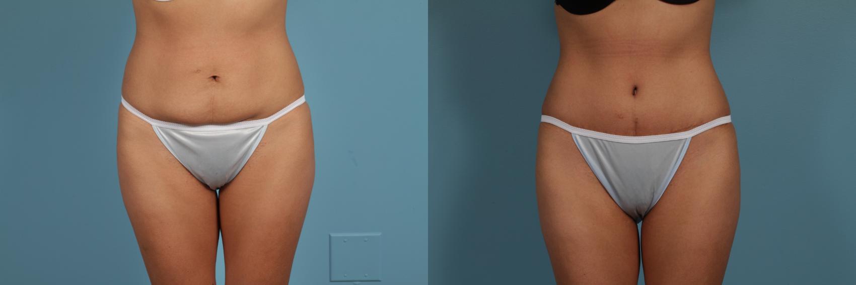 Before & After Tummy Tuck by Dr. Mustoe Case 298 View #1 View in Chicago, IL