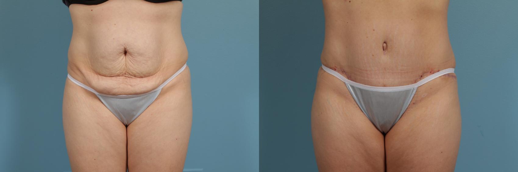 Before & After Tummy Tuck by Dr. Mustoe Case 299 View #1 View in Chicago, IL