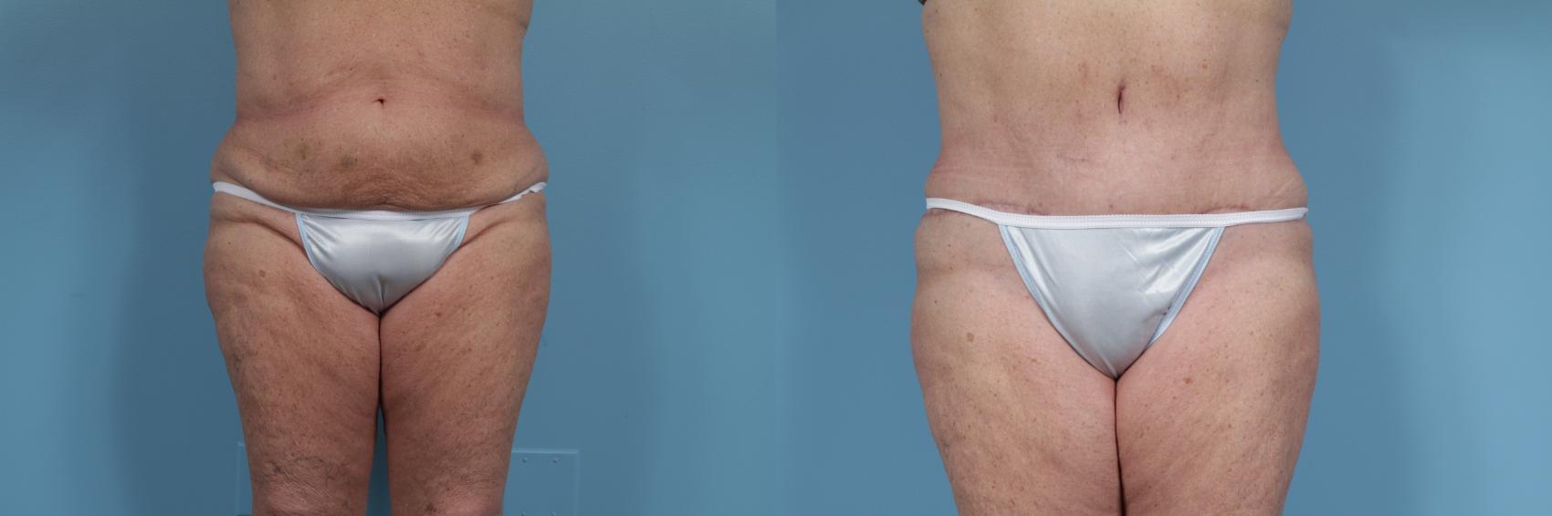 Before & After Tummy Tuck by Dr. Mustoe Case 354 View #1 View in Chicago, IL