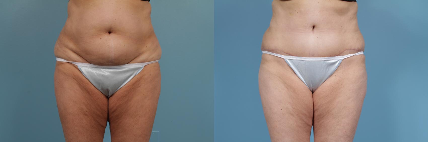 Before & After Tummy Tuck by Dr. Mustoe Case 355 View #1 View in Chicago, IL
