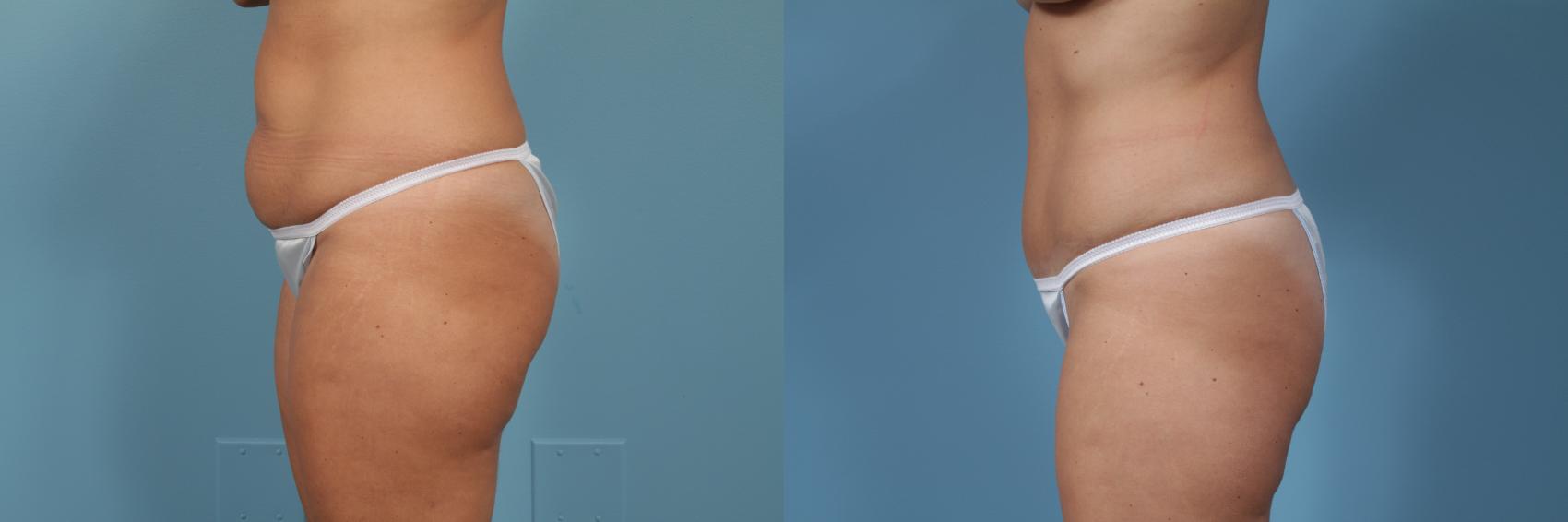 Before & After Tummy Tuck by Dr. Mustoe Case 364 View #1 View in Chicago, IL
