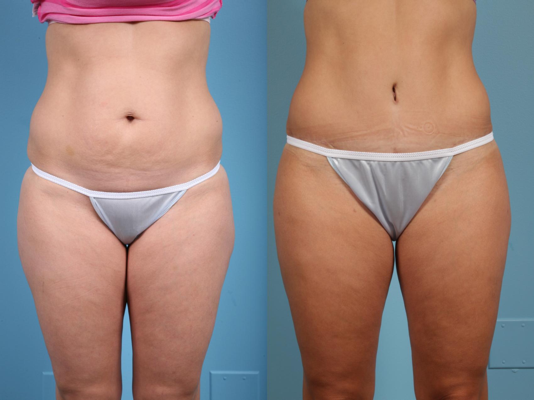 Before & After Tummy Tuck by Dr. Mustoe Case 39 View #1 View in Chicago, IL