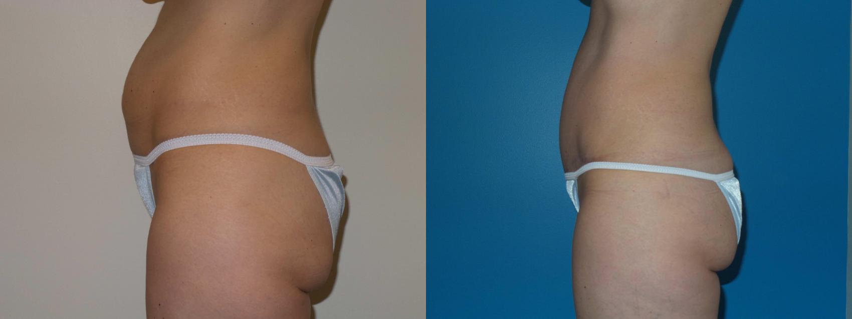 Before & After Tummy Tuck by Dr. Mustoe Case 399 View #1 View in Chicago, IL