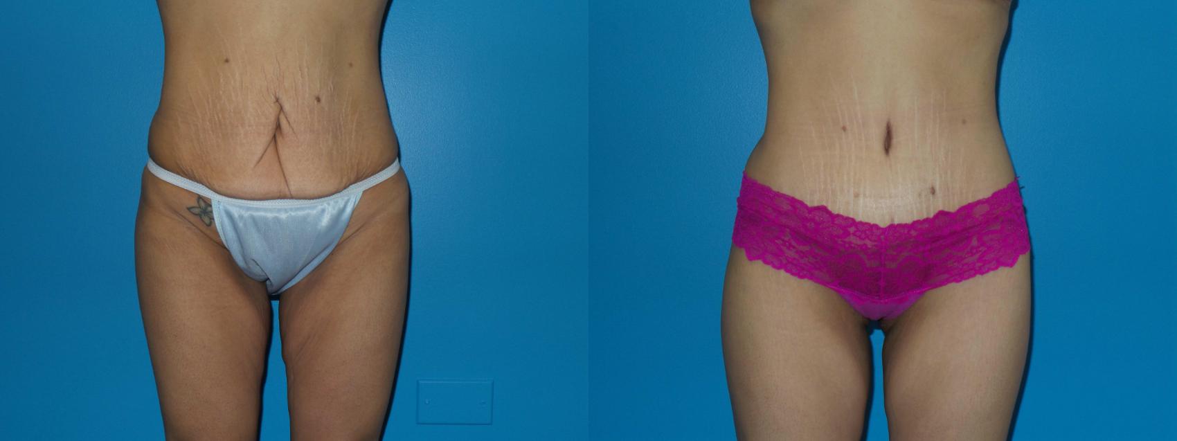 Before & After Tummy Tuck by Dr. Mustoe Case 410 View #1 View in Chicago, IL
