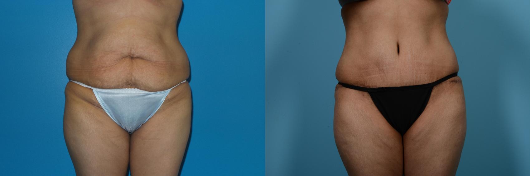 Before & After Tummy Tuck by Dr. Mustoe Case 462 View #1 View in Chicago, IL