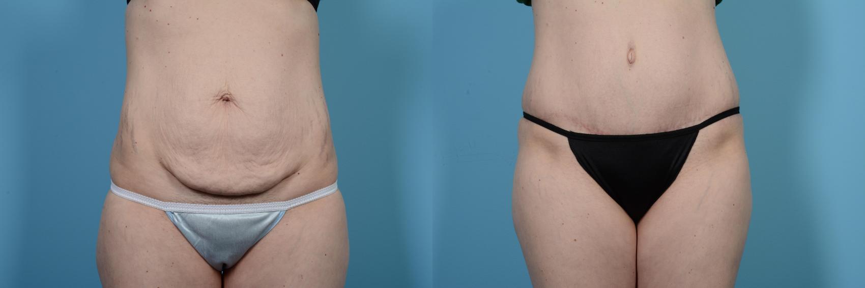 Before & After Tummy Tuck by Dr. Mustoe Case 471 View #1 View in Chicago, IL