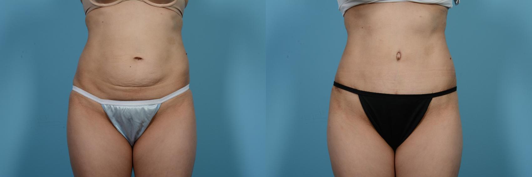 Before & After Tummy Tuck by Dr. Mustoe Case 479 View #1 View in Chicago, IL