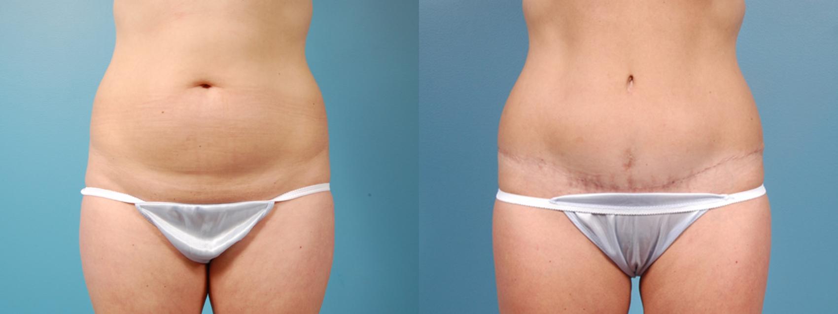 Before & After Tummy Tuck by Dr. Mustoe Case 5 View #1 View in Chicago, IL