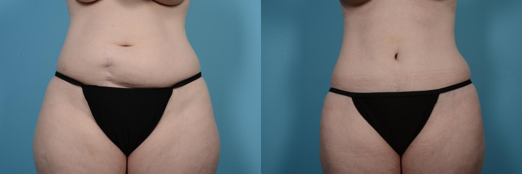 Before & After Tummy Tuck by Dr. Mustoe Case 504 View #1 View in Chicago, IL