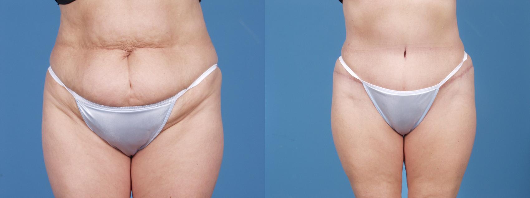 Before & After Tummy Tuck by Dr. Mustoe Case 54 View #1 View in Chicago, IL