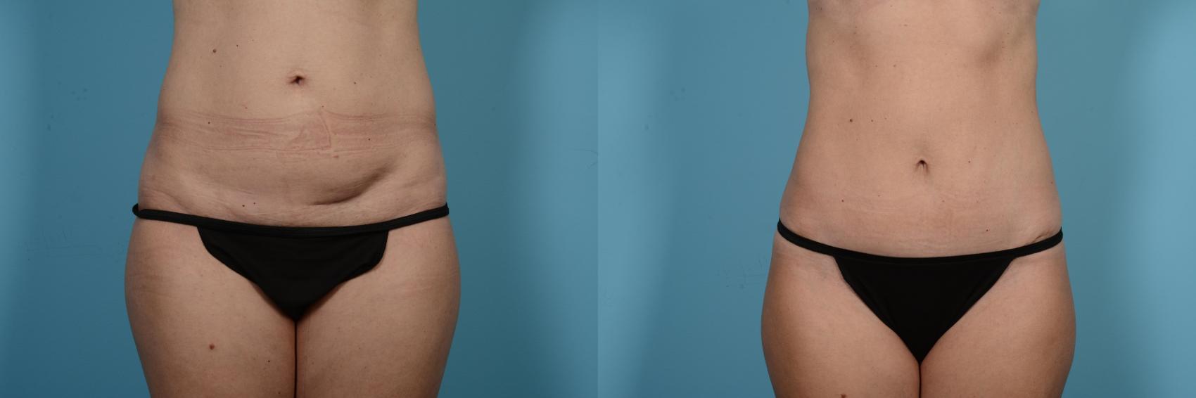 Before & After Tummy Tuck by Dr. Mustoe Case 550 Front View in Chicago, IL
