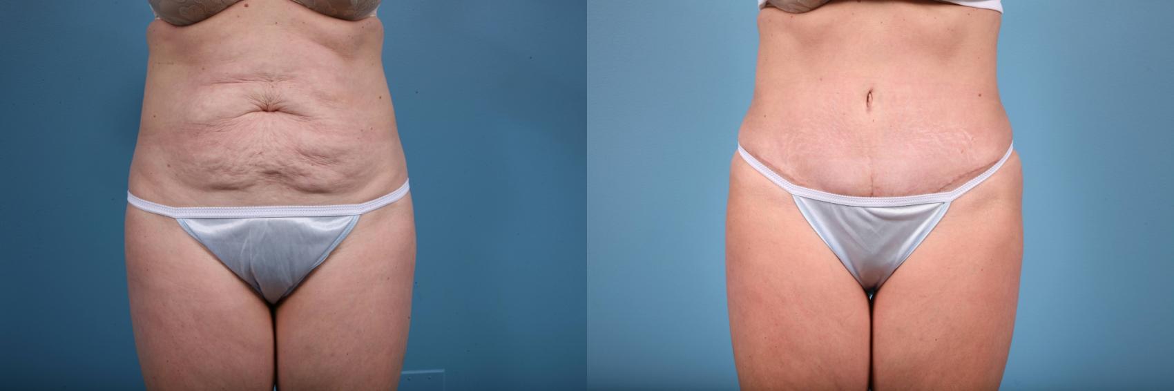 Before & After Tummy Tuck by Dr. Mustoe Case 64 View #1 View in Chicago, IL