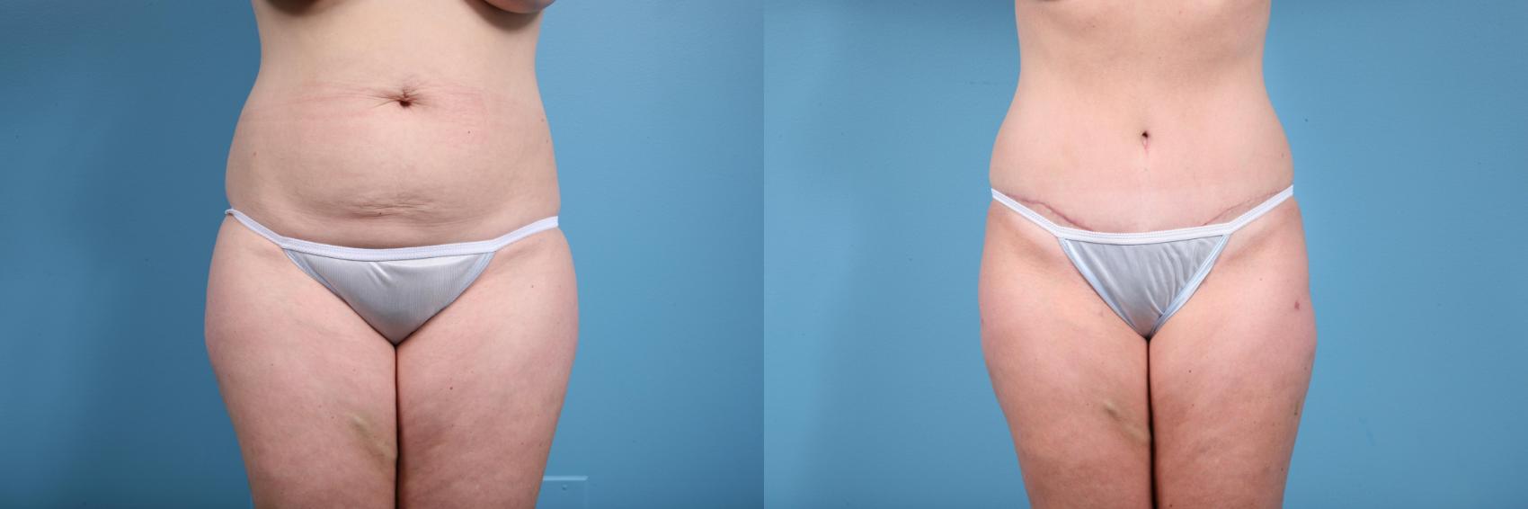 Before & After Tummy Tuck by Dr. Mustoe Case 73 View #1 View in Chicago, IL