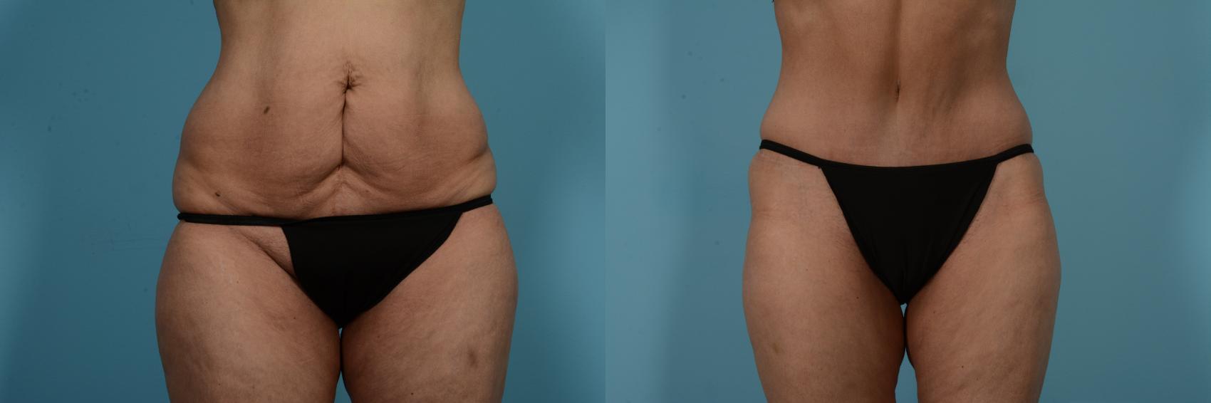 Before & After Tummy Tuck by Dr. Mustoe Case 733 Front View in Chicago, IL