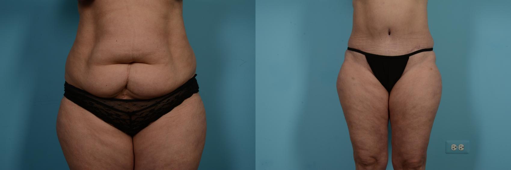 Before & After Tummy Tuck by Dr. Mustoe Case 734 Front View in Chicago, IL
