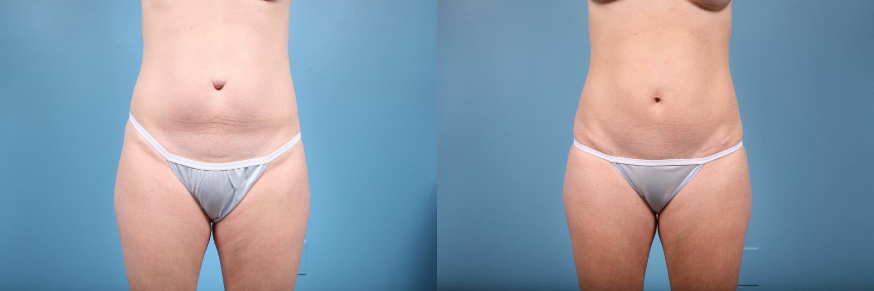 Before & After Tummy Tuck by Dr. Mustoe Case 75 View #1 View in Chicago, IL