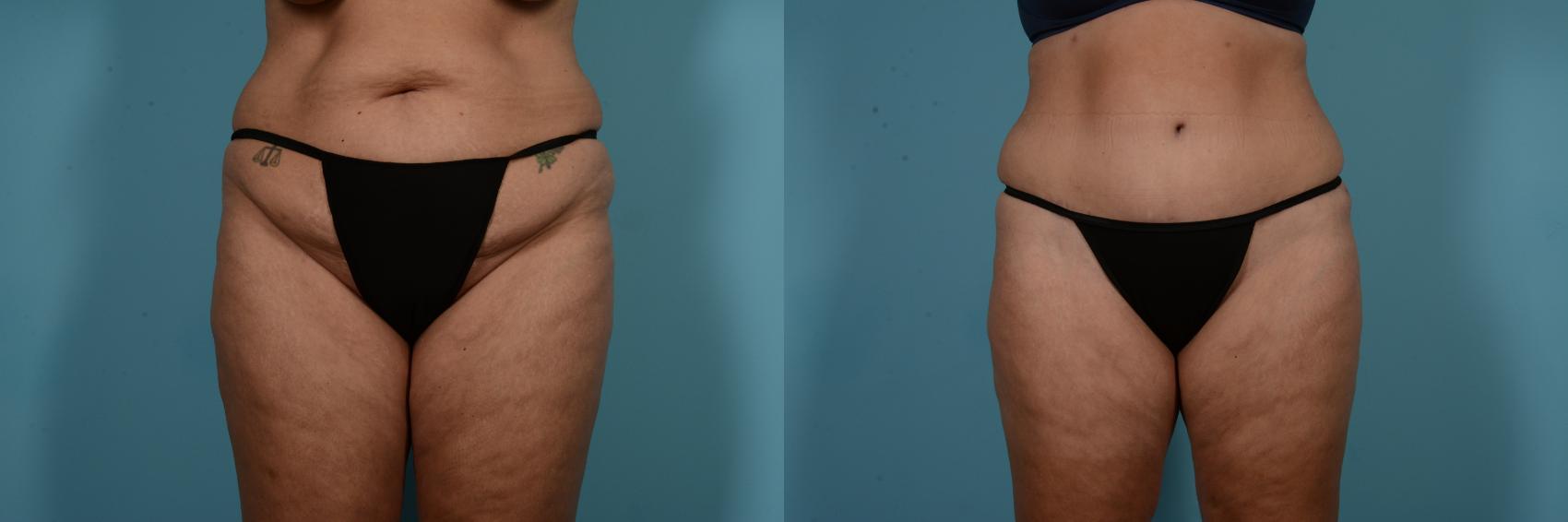 Before & After Tummy Tuck by Dr. Mustoe Case 769 Front View in Chicago, IL