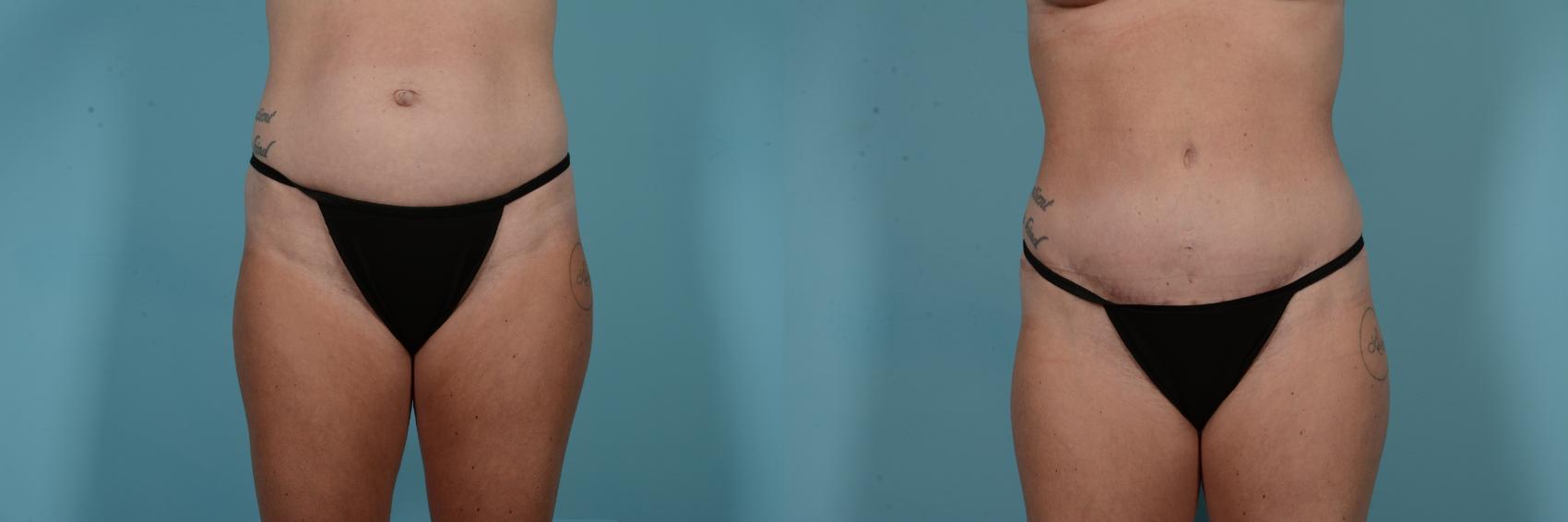 Before & After Tummy Tuck by Dr. Mustoe Case 798 Front View in Chicago, IL