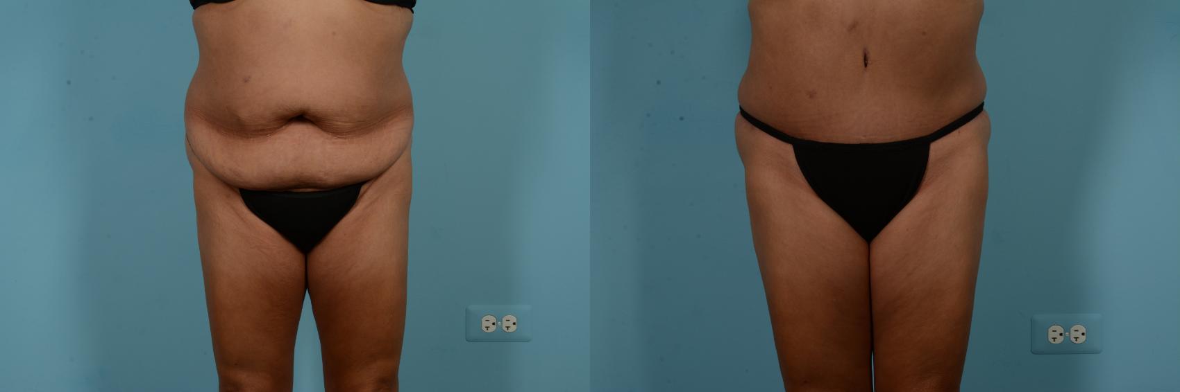 Before & After Tummy Tuck by Dr. Mustoe Case 824 Front View in Chicago, IL