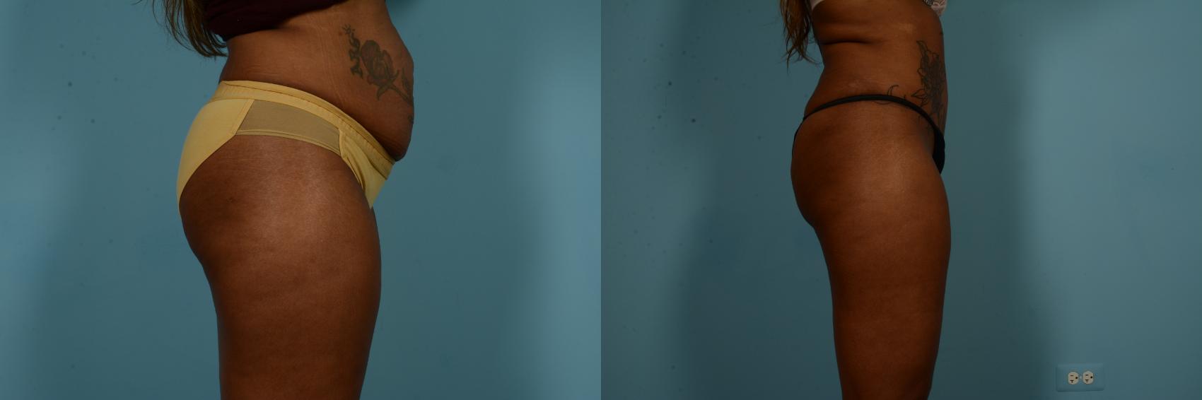 Before & After Tummy Tuck by Dr. Mustoe Case 840 Right Side View in Chicago, IL