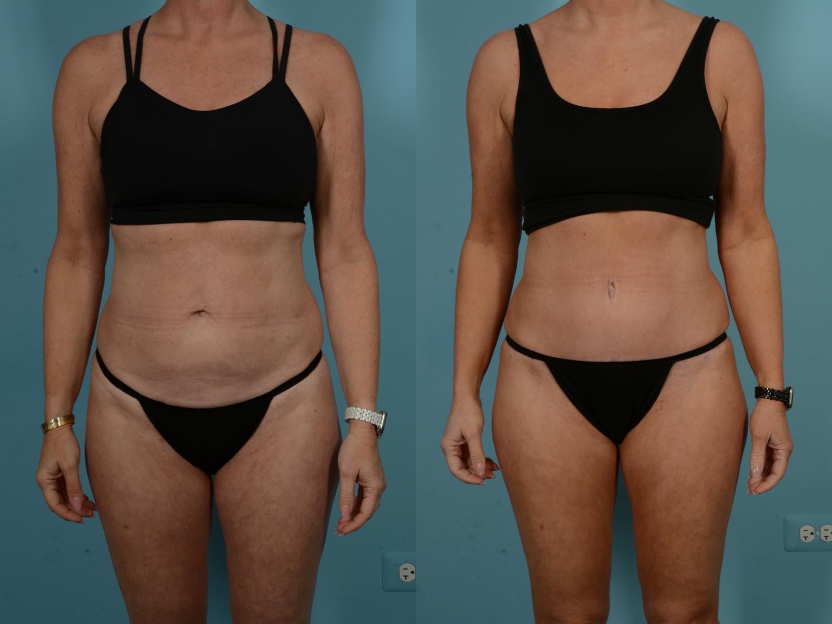 Before & After Tummy Tuck by Dr. Sinno Case 1098 Front View in Chicago, IL