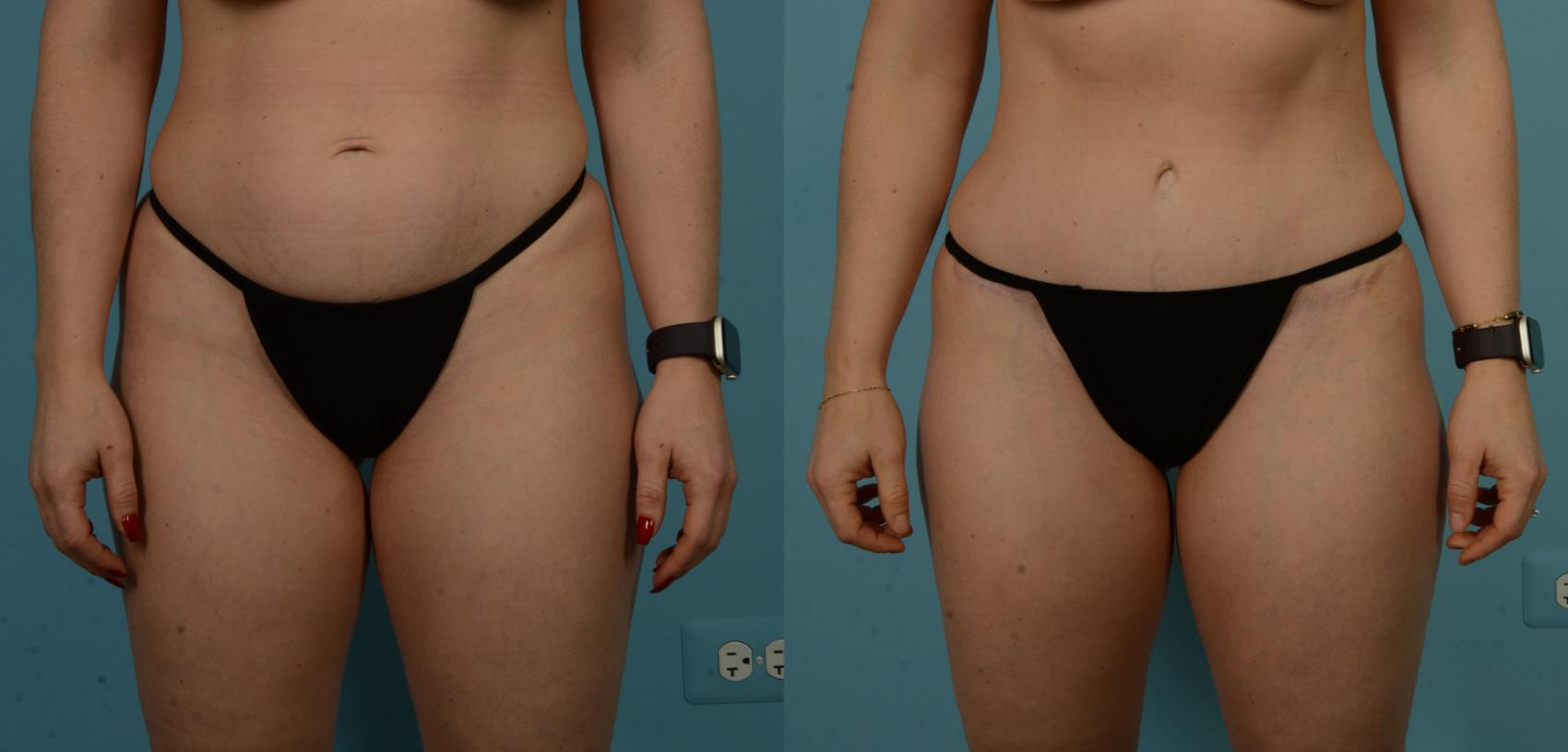 Before & After Tummy Tuck by Dr. Sinno Case 1100 Front View in Chicago, IL