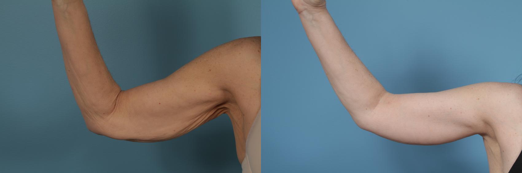 Before & After Arm Lift (Brachioplasty) Case 282 View #1 View in Chicago, IL
