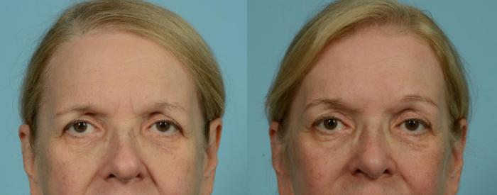 Before & After Blepharoplasty by Dr. Mustoe Case 1058 Front View in Chicago, IL